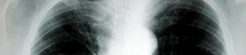 broncopulmonar