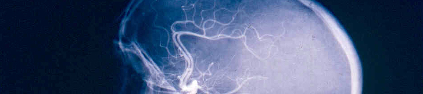 neurocirugia