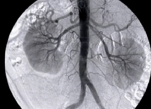cirugia vascular